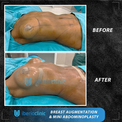 Operaci�n est�tica